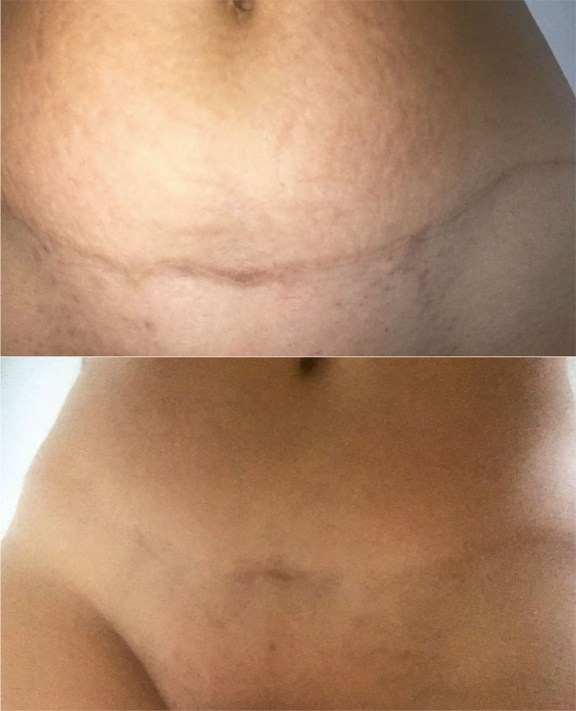 Abdominoplastia y estrías