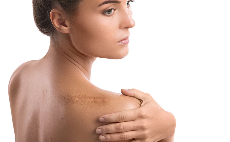 Camuflaje de cicatrices