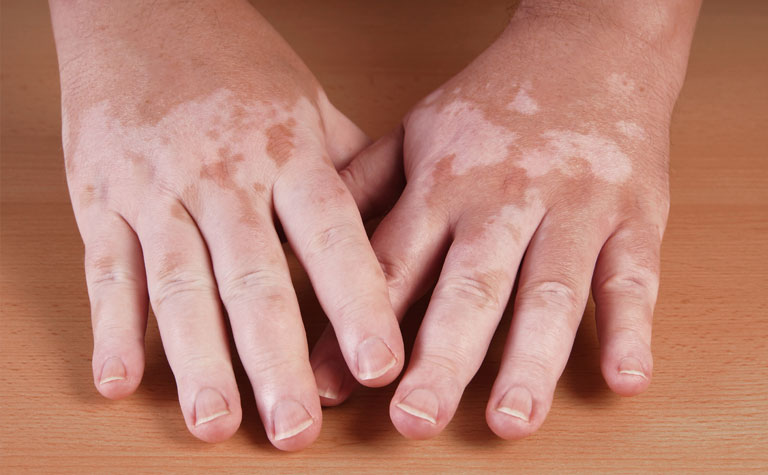 Camuflaje de vitiligo